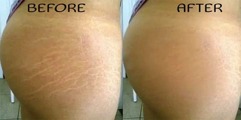 how-to-remove-stretch-marks-beauty-and-laser-clinic